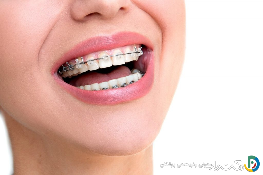 چگونه ارتودنسی باعث تنظیم دندان ها می شود؟