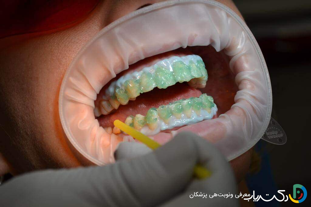 چگونه بلیچینگ دندان باعث سفیدتر شدن آن می شود؟