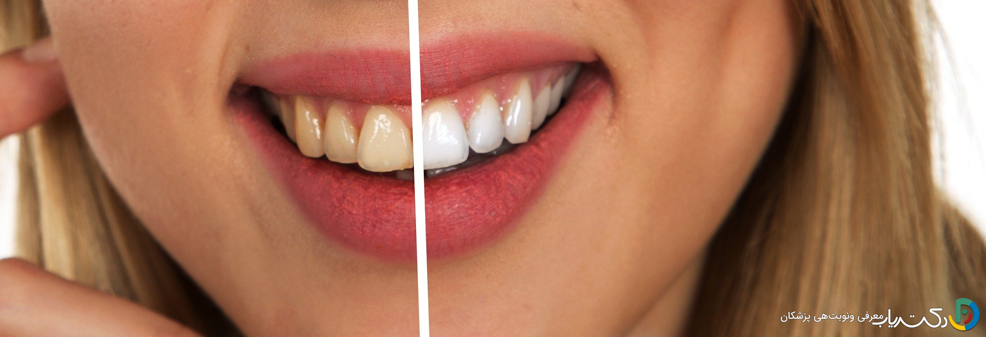 چقدر زمان می برد تا بلیچینگ دندان انجام شود؟
