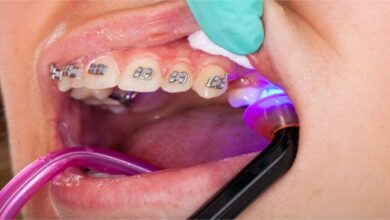 چه مدت زمان برای انجام درمان ارتودنسی نیاز است؟