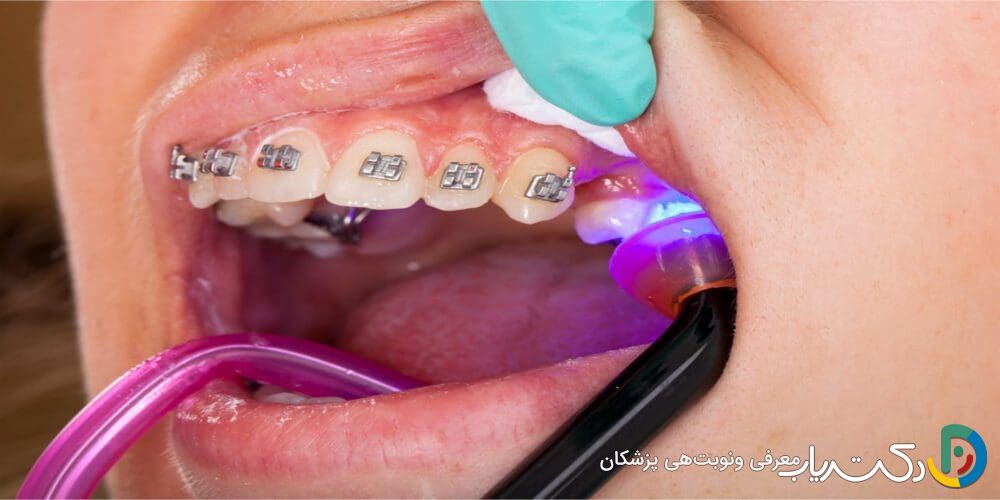 چه مدت زمان برای انجام درمان ارتودنسی نیاز است؟