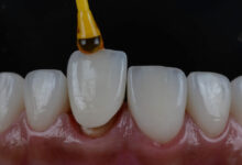 چقدر زمان می برد تا روکش دندان نصب شود؟