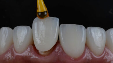 چقدر زمان می برد تا روکش دندان نصب شود؟
