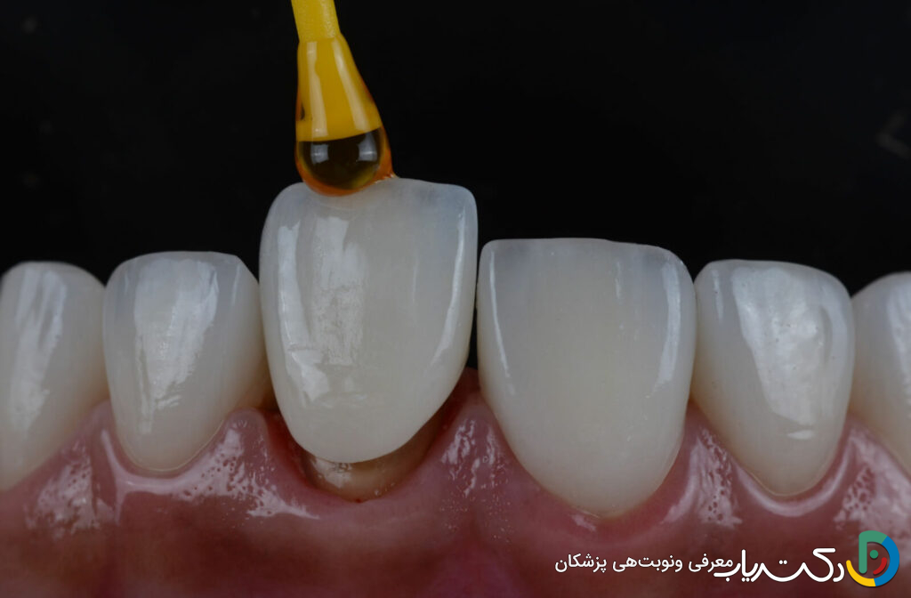 چقدر زمان می برد تا روکش دندان نصب شود؟