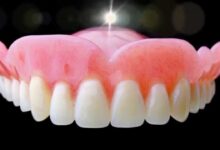 چقدر زمان می برد تا دندان مصنوعی نصب شود؟