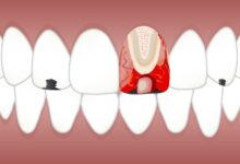 چه مدت زمان برای ترمیم دندان نیاز است؟