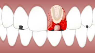 چه مدت زمان برای ترمیم دندان نیاز است؟