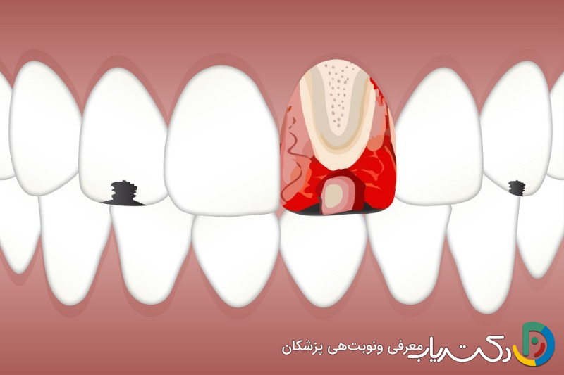 چه مدت زمان برای ترمیم دندان نیاز است؟