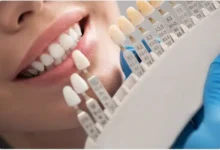 چگونه از روکش دندان مراقبت کنیم؟