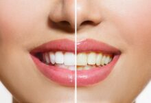 چگونه کامپوزیت دندان را تمیز نگه داریم؟