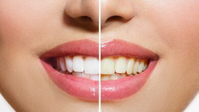 چگونه کامپوزیت دندان را تمیز نگه داریم؟