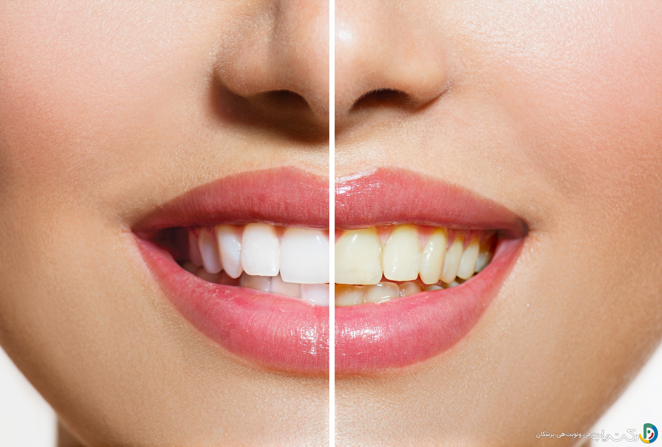 چگونه کامپوزیت دندان را تمیز نگه داریم؟