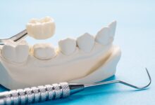 چطور می توان روکش دندان را تمیز نگه داشت؟