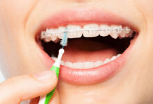 چطور ارتودنسی خود را تمیز نگه داریم؟