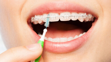 چطور ارتودنسی خود را تمیز نگه داریم؟