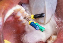 چگونه از عفونت بعد از عصب کشی جلوگیری کنیم؟