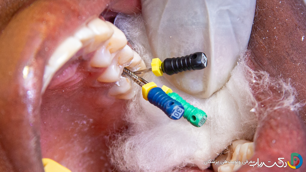 چگونه از عفونت بعد از عصب کشی جلوگیری کنیم؟