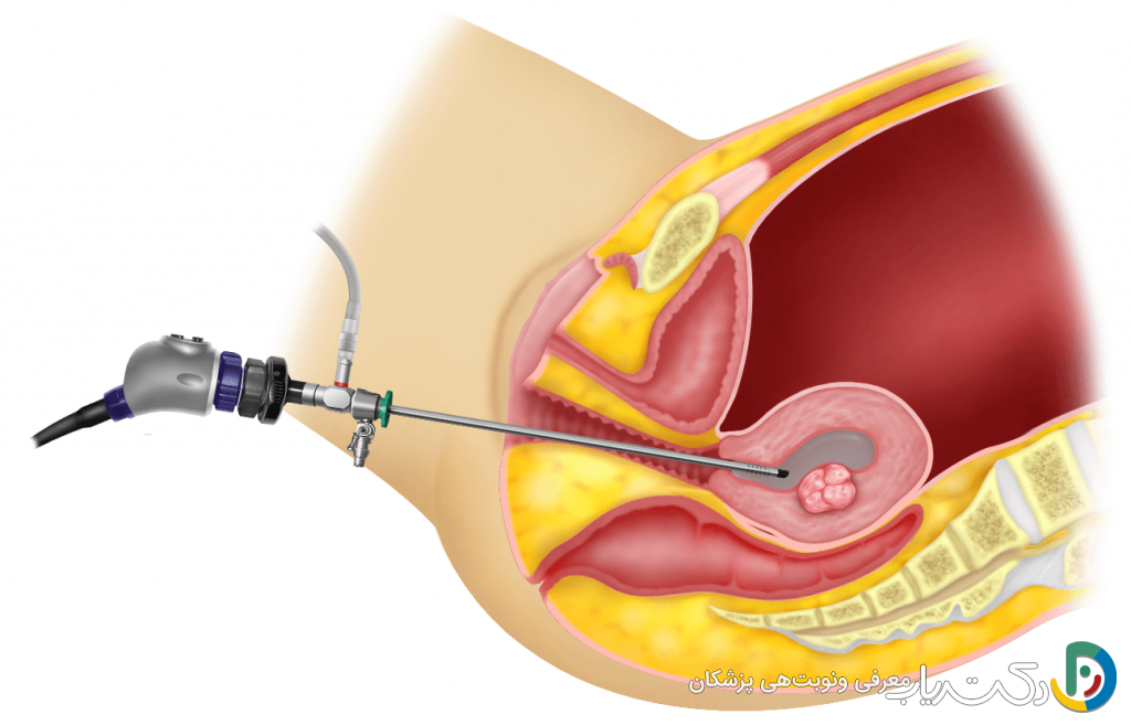 قیمت هیستروسکوپی در تهران (تعرفه های دولتی و خصوصی)
