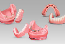 اوردنچر ایمپلنت چیست ؟ مزایا و معایت آن