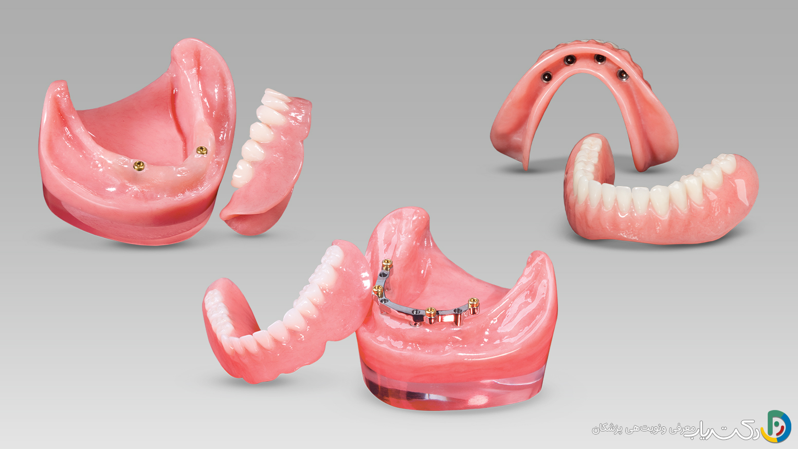 اوردنچر ایمپلنت چیست ؟ مزایا و معایت آن