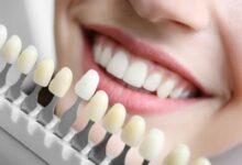 آیا کامپوزیت دندان برای دندان های جلو بهتر است؟