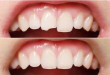 آیا کامپوزیت دندان مقاوم است؟