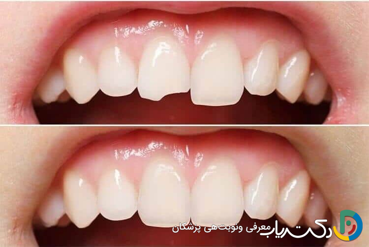 آیا کامپوزیت دندان مقاوم است؟