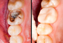 آیا کامپوزیت دندان برای دندان های عقب مؤثر است؟
