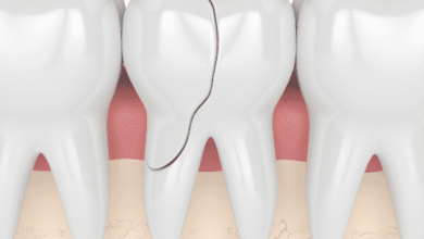 آیا کامپوزیت دندان در درمان دندان های ترک خورده مؤثر است؟