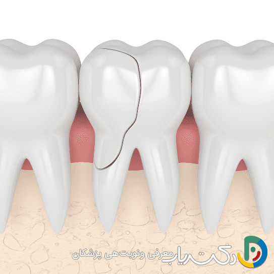 آیا کامپوزیت دندان در درمان دندان های ترک خورده مؤثر است؟