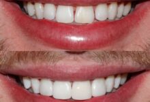 آیا کامپوزیت دندان برای همه نوع دندان مناسب است؟