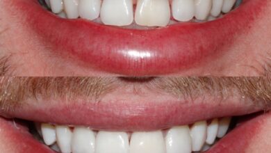 آیا کامپوزیت دندان برای همه نوع دندان مناسب است؟