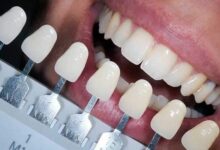 آیا کامپوزیت دندان برای دندان های پوسیده مناسب است؟