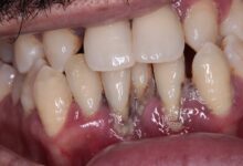 آیا ترمیم دندان برای افرادی که بیماری های لثه دارند مؤثر است؟