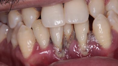 آیا ترمیم دندان برای افرادی که بیماری های لثه دارند مؤثر است؟