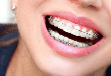 آیا ارتودنسی برای هر فرد به یک اندازه هزینه بر است؟