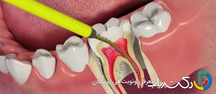 آیا عصب کشی دندان از نظر مالی مقرون به صرفه است؟