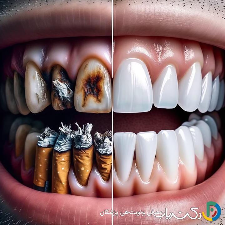 آیا بلیچینگ دندان برای افرادی که سیگار می کشند مؤثر است؟