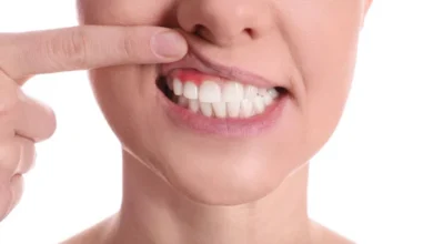 آیا بلیچینگ دندان برای افرادی که مشکلات لثه دارند مناسب است؟