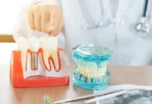 آیا برای انجام ایمپلنت محدودیت سنی وجود دارد؟