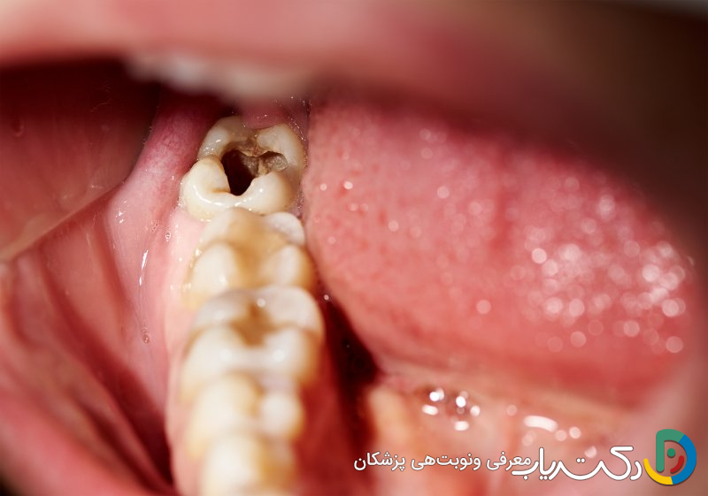 آیا بلیچینگ دندان برای دندان های پوسیده مؤثر است؟