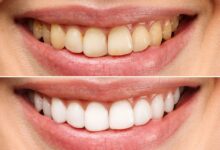 آیا بلیچینگ دندان برای دندان های زرد مؤثر است؟