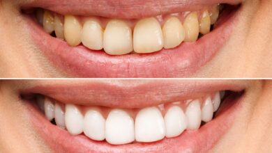 آیا بلیچینگ دندان برای دندان های زرد مؤثر است؟