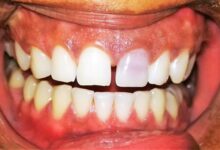 آیا بلیچینگ دندان برای افرادی که دندان های پوسیده دارند مناسب است؟