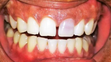 آیا بلیچینگ دندان برای افرادی که دندان های پوسیده دارند مناسب است؟