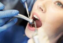 آیا عصب کشی در دوران بارداری امکان پذیر است؟