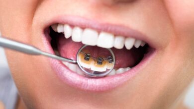 ارتودنسی لینگوال یا ارتودنسی پشت دندانی چیست ؟