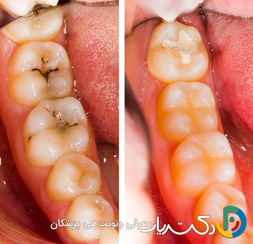 آیا تحقیقات جدید نشان داده اند که ترمیم دندان مقاوم تر از گذشته