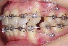 ارتودنسی مینی اسکرو چیست ؟ مزایا و معایب آن