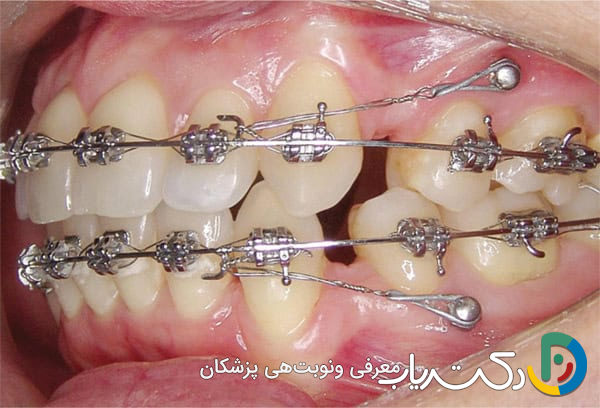 ارتودنسی مینی اسکرو چیست ؟ مزایا و معایب آن
